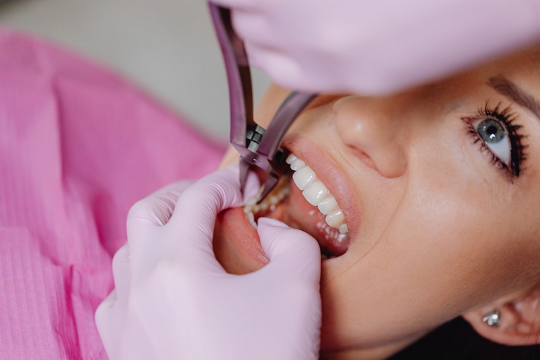 Come risolvere gli inestetismi dei denti