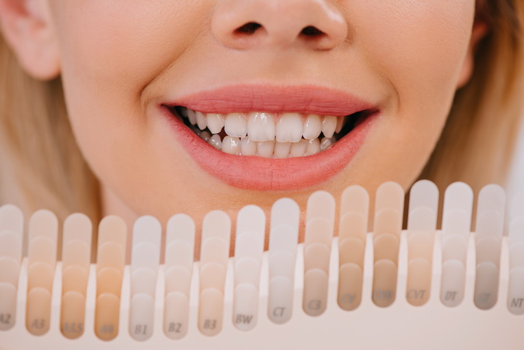 Come Sbiancare i Denti: dai metodi professioni a quelli casalinghi