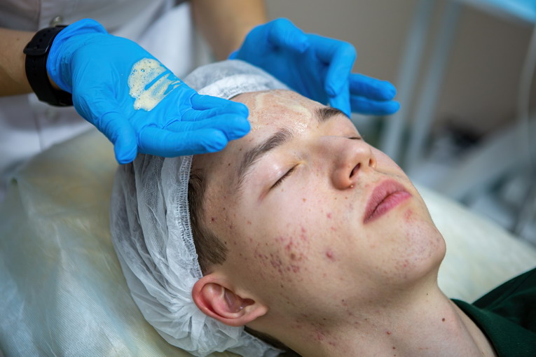 Come gestire l’acne cicatriziale