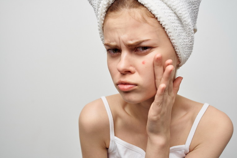 Come scegliere la giusta skincare per l’acne