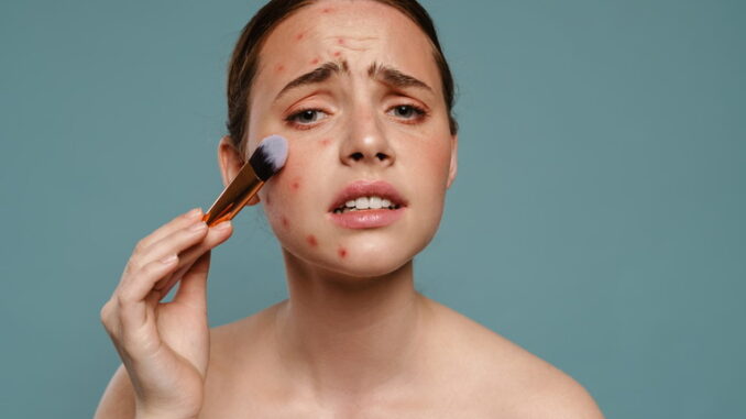 Stress e acne: qual è il collegamento? acne