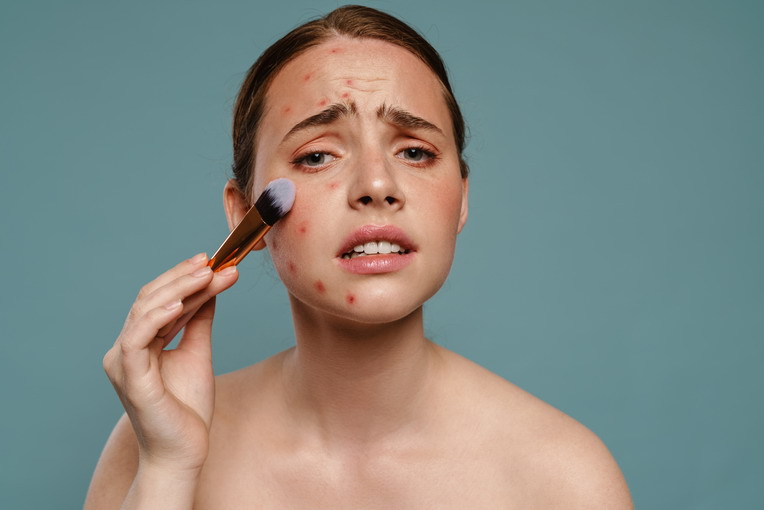 Stress e acne: qual è il collegamento?