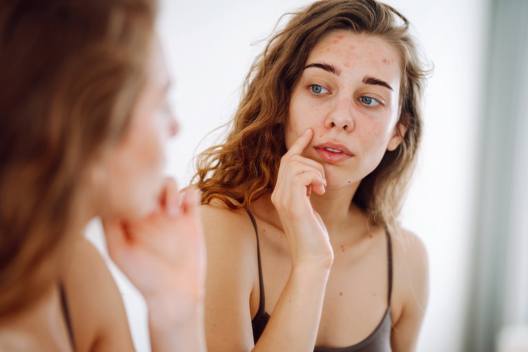 L’importanza della routine nella prevenzione dell’acne
