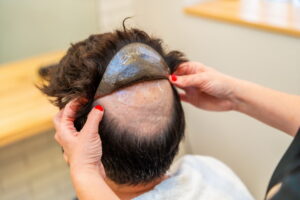 Alopecia androgenetica: cause e rimedi efficaci