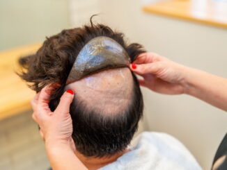 Alopecia androgenetica: cause e rimedi efficaci