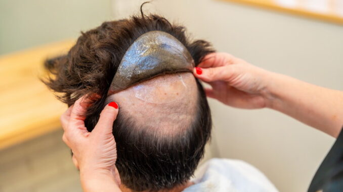 Alopecia androgenetica: cause e rimedi efficaci