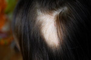 Alopecia: cause, sintomi e soluzioni