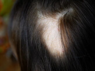 Alopecia: cause, sintomi e soluzioni