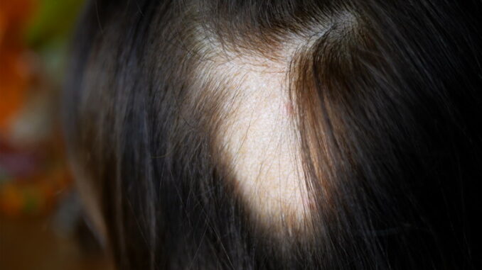 Alopecia: cause, sintomi e soluzioni