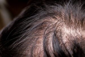 Rimedi naturali per l'alopecia: funzionano davvero?