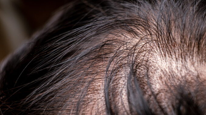 Rimedi naturali per l'alopecia: funzionano davvero?