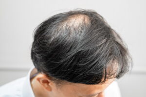 Trapianto di capelli: soluzione per l'alopecia avanzata