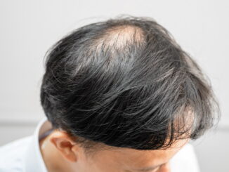 Trapianto di capelli: soluzione per l'alopecia avanzata