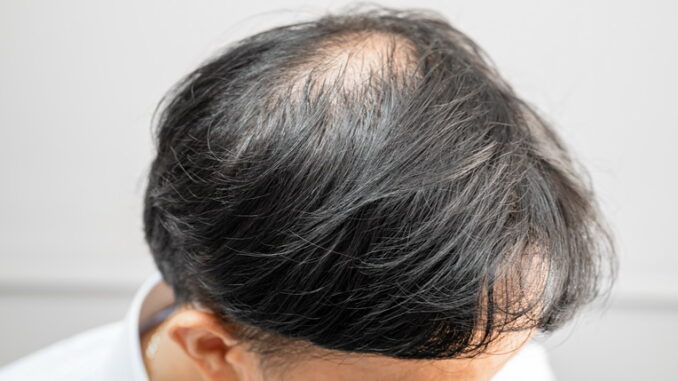 Trapianto di capelli: soluzione per l'alopecia avanzata