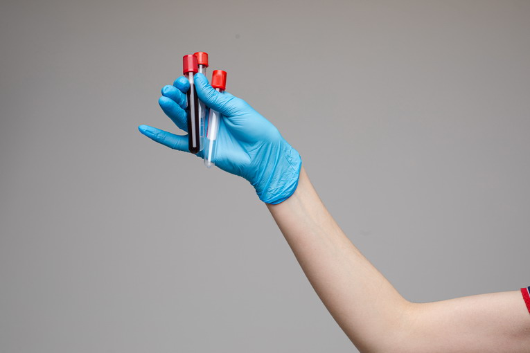 Glicemia e HbA1c: i parametri per monitorare il diabete